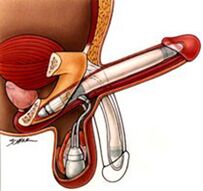 Implanty powiększające penisa męskiego